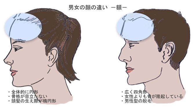 額の女性化（額の毛髪移植） タイSRS 性別適合手術 性転換アテンド会社 タイSRSガイドセンター