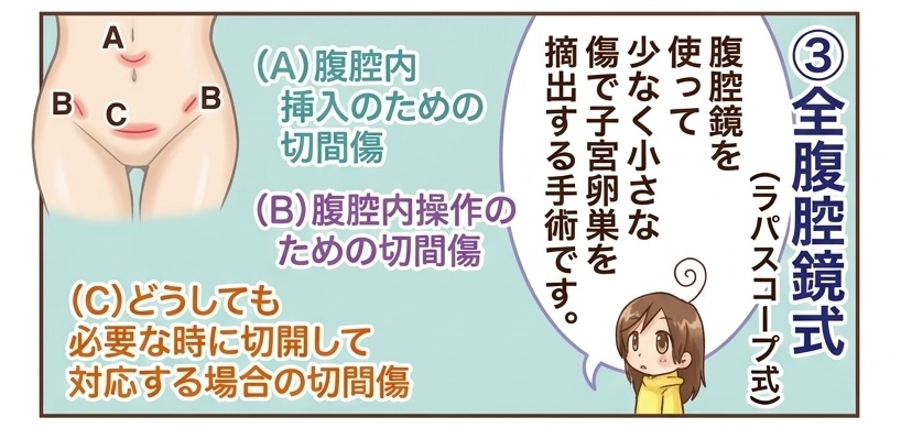 07子宮卵巣摘出手術の違いとメリットデメリット02
